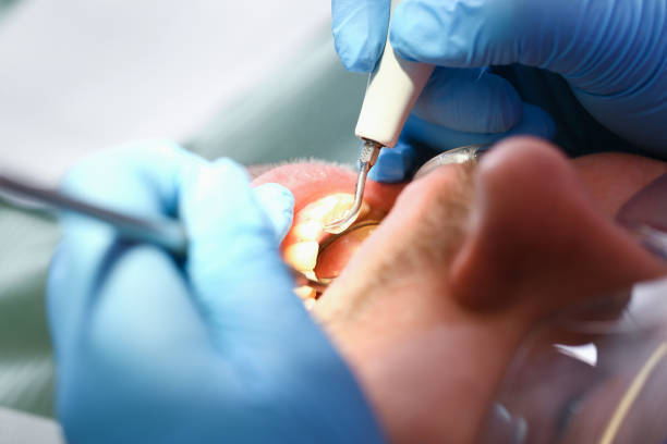 Best Emergency Tooth Extraction in Monee, IL