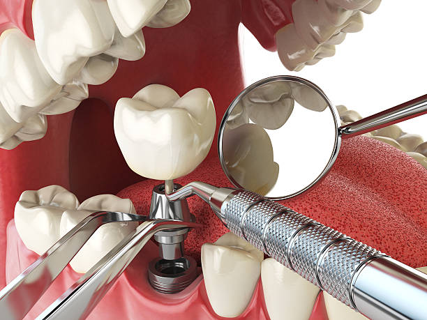 Best Emergency Tooth Extraction in Monee, IL
